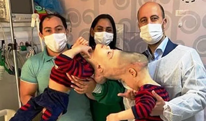 Kashmir Surgeon Separates Brazilian Twins With Fused Brains.